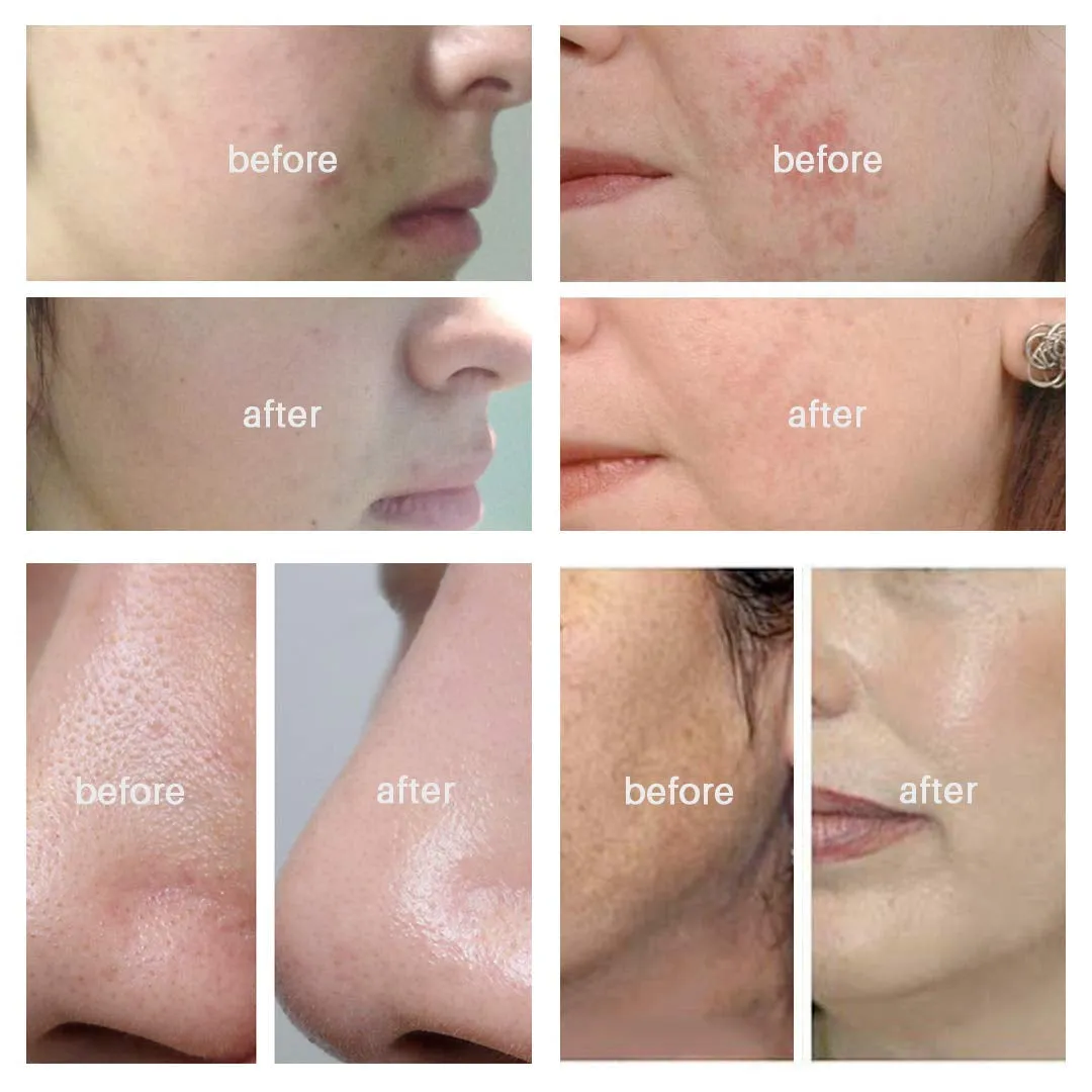 Diamond Microdermabrasion Machine Home Handheld Microderm Rechargeable Device 4 Modes Blackhead Remover Vacuum Suction Tool Skin Care Home Use Salon Result Kit Valentine'S Day Gift for Women